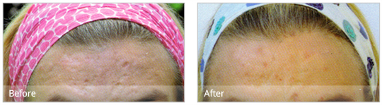 Dermaroller treatment can improve the appearance of acne scars