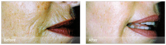 Dermaroller treatment can improve the appearance of aged and sun damaged skin