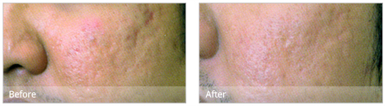 Dermaroller treatment can dramatically improve the appearance of acne scars