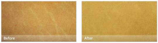 Dermaroller treatment can improve the appearance of stretch marks on your skin