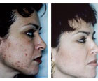 dermabrasion, blackheads, acne, oily skin, scarring, sun damaged skin