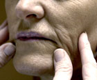lines, wrinkles, low collagen, skin damage,  dermal fillers, botox injections