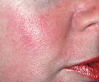 rosacea, oily skin, pimples, forehead, chemical peel, dermabrasion